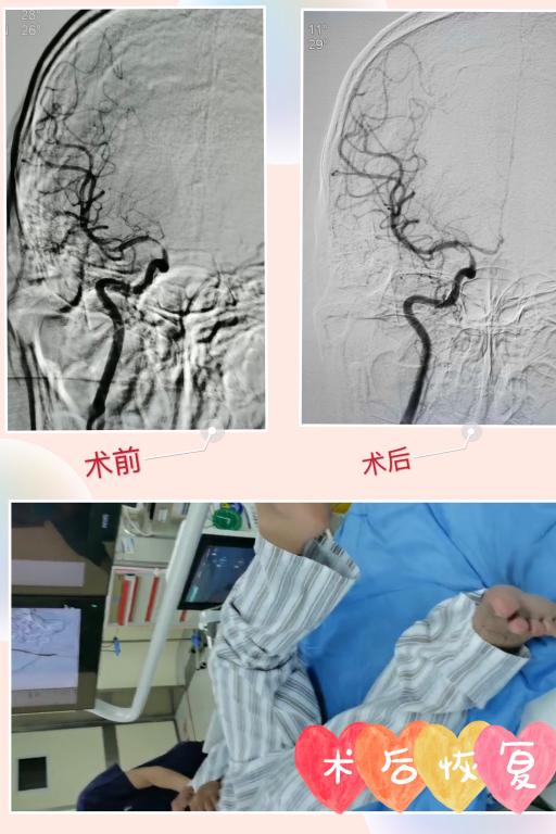 動脈溶栓,球囊支架,介入取栓),在閻良區都是一枝獨秀,專業只為守護您